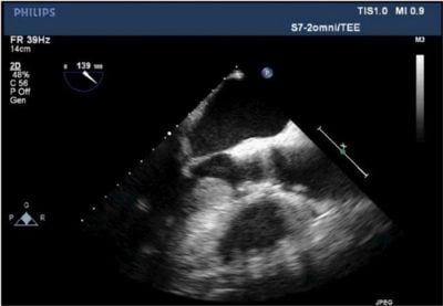 Classic âHockey Stickingâ of mitral valve leaflet contributing to LVOT obstruction