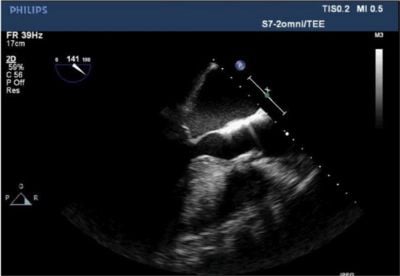 Relief of LVOT obstruction following medical intervention