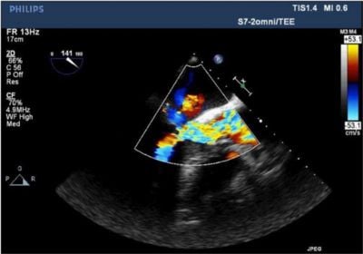 Doppler flow showing relief of LVOT obstruction and increased flow through LVOT