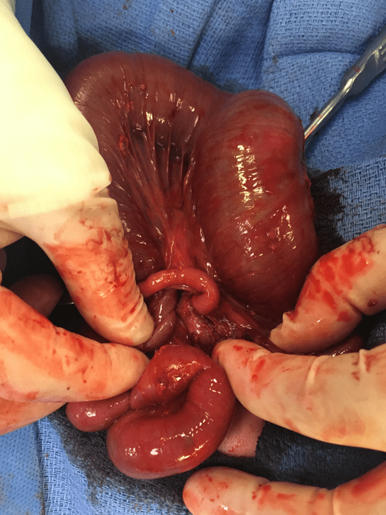 Image 5a: Operative photo depicting a Type IIIb intestinal atresia with an internal hernia through a mesenteric defect