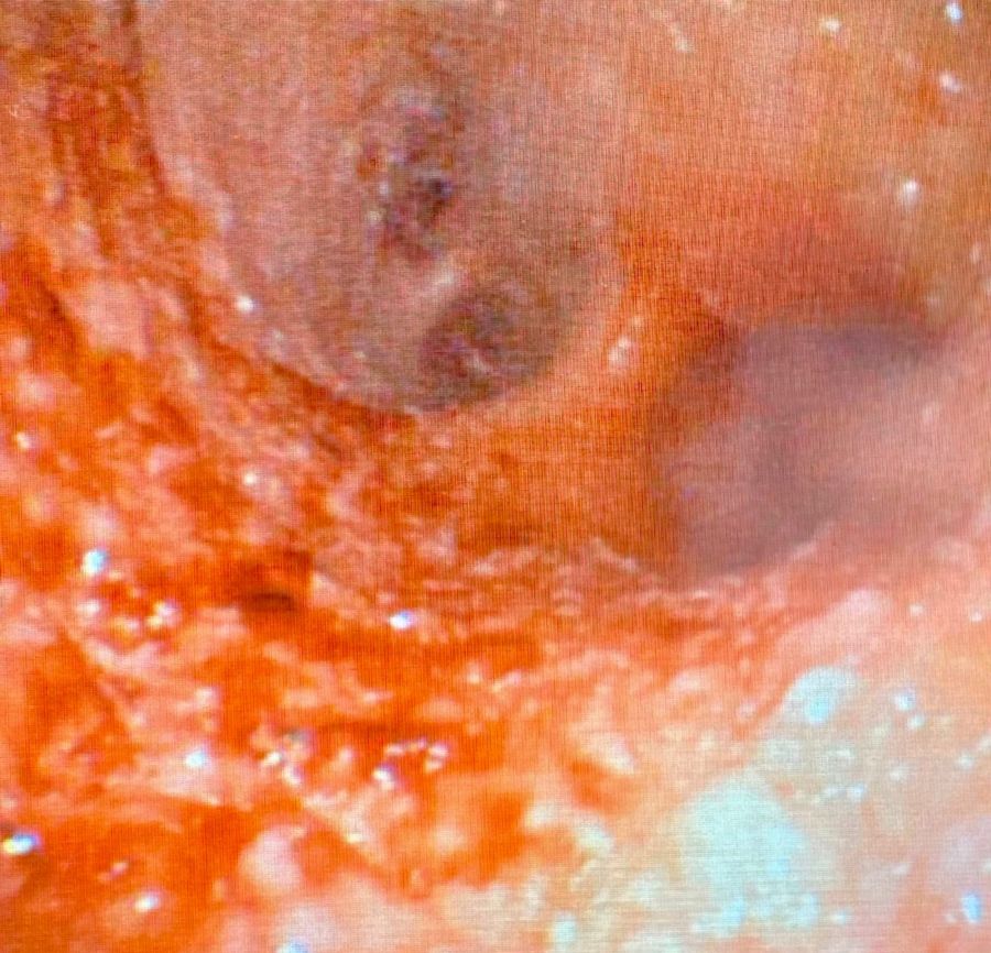 Figure 1: Friable mucosa with ulcerations visible on initial bronchoscopy, left mainstem bronchus.