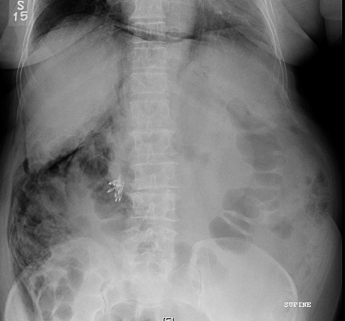Figure 2.  Post-procedure X-ray showing free air.