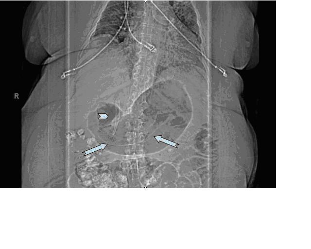 Figure: Scout film demonstrating the successful placement of self expandable biliary (arrowhead) and enteric metal stents (arrows) are shown in this obese patinet