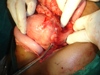 Intraoperative findings-Intussusception