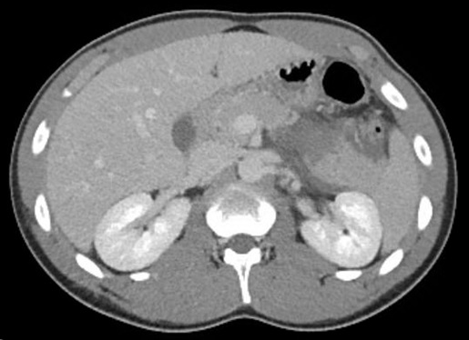 FIRST ROBOTIC SPLEEN PRESERVING DISTAL PANCREATECTOMY FOR TRAUMA ...